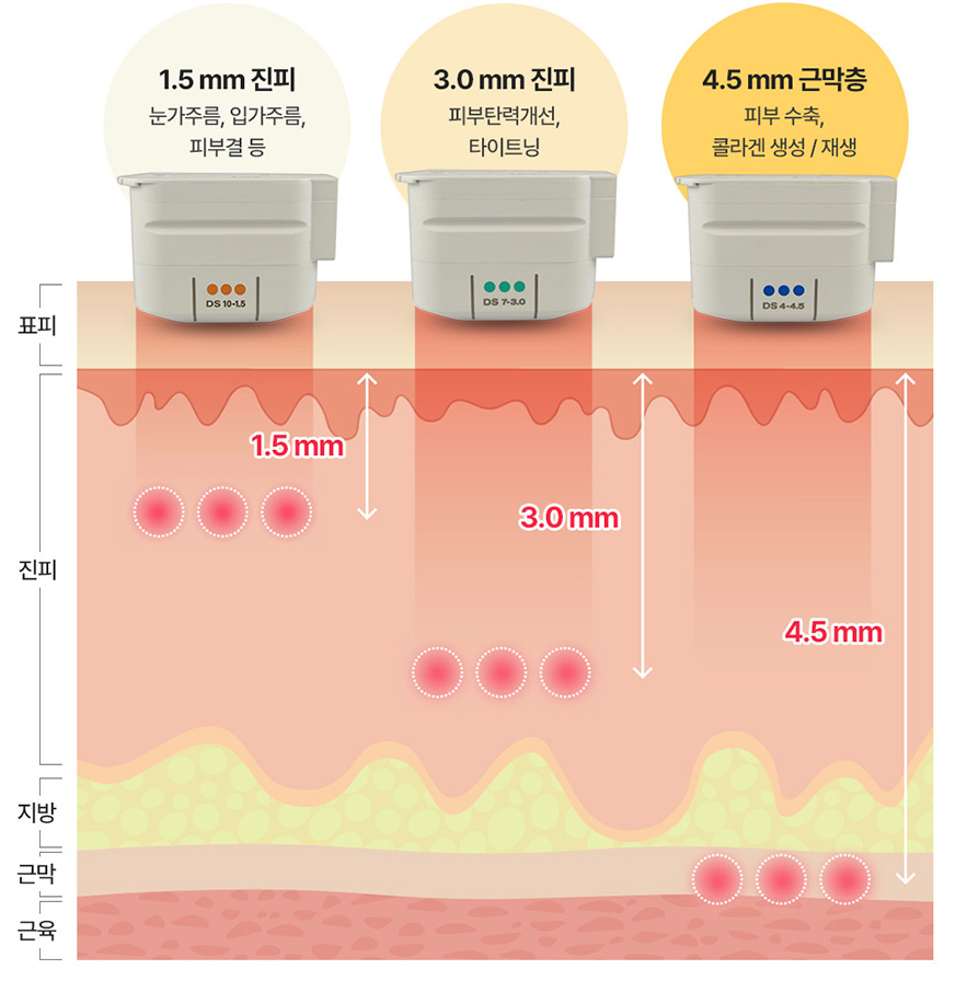 1.5毫米深度的膚淺層 – 適用於改善眼角皺紋、嘴角皺紋及肌膚紋理等問題 | 3.0毫米深度的膚淺層 – 可提升肌膚彈性，達到緊致效果 | 4.5毫米深度的筋膜層 – 能促進肌膚收縮，並刺激膠原蛋白的生成與再生